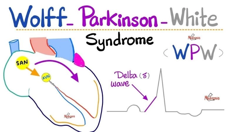 Causes Of WPW Syndrome linked to extra pathway