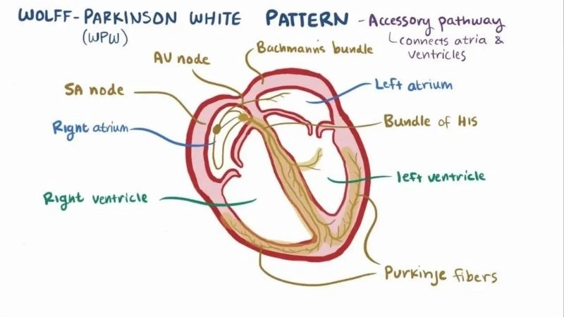 WPW Syndrome Vs SVT key difference in rhythm