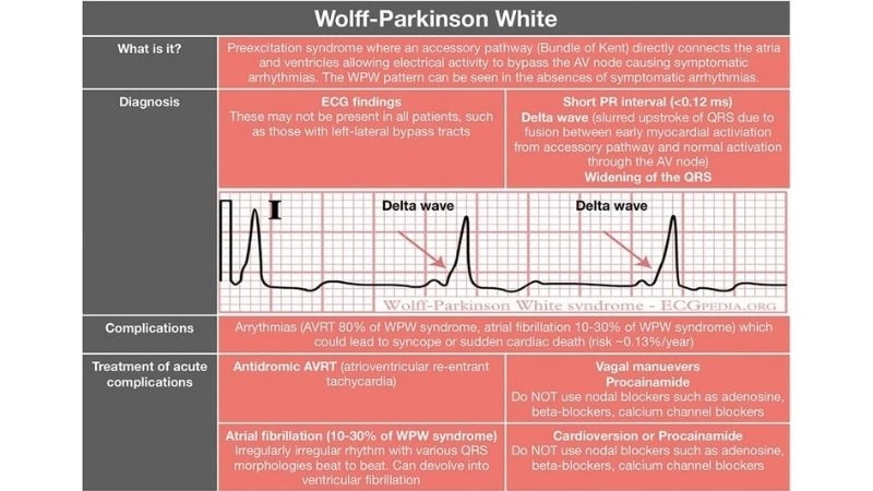 WPW And Atrial Fibrillation increase sudden risk