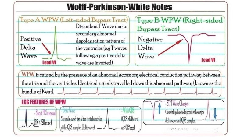 WPW And Sudden Cardiac Death highlight true danger