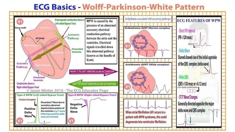 WPW Syndrome ECG shows classic delta wave pattern
