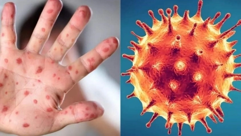 Yaba Monkey Tumor Virus Infection impacts primate disease research