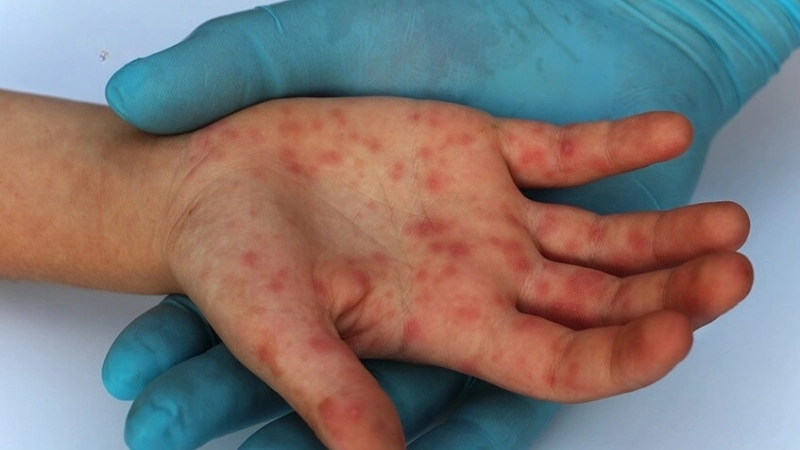 Yaba Monkey Tumor Virus Infection relates to yaba-like disease virus