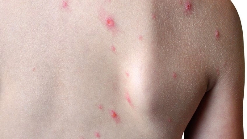 Yaba Monkey Tumor Virus Infection may cause cutaneous histiocytoma