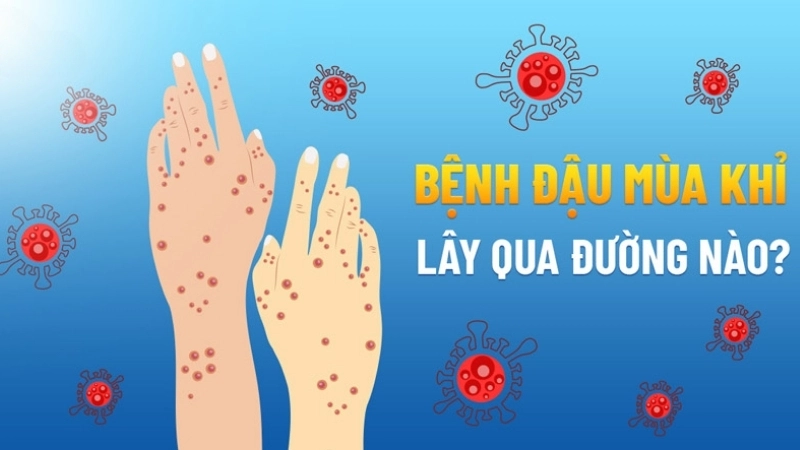 Yaba Monkey Tumor Virus Infection links to monkeypox virus