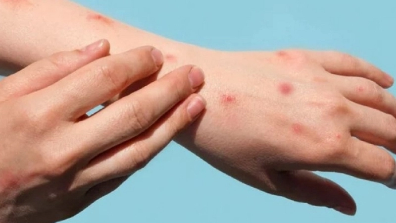 Yaba Monkey Tumor Virus Infection spreads through viral transmission