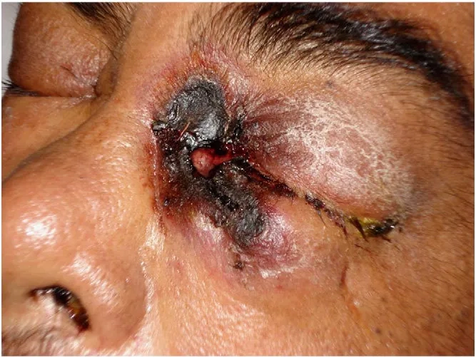 Jock itch (tinea cruris) - Causes and effective treatments