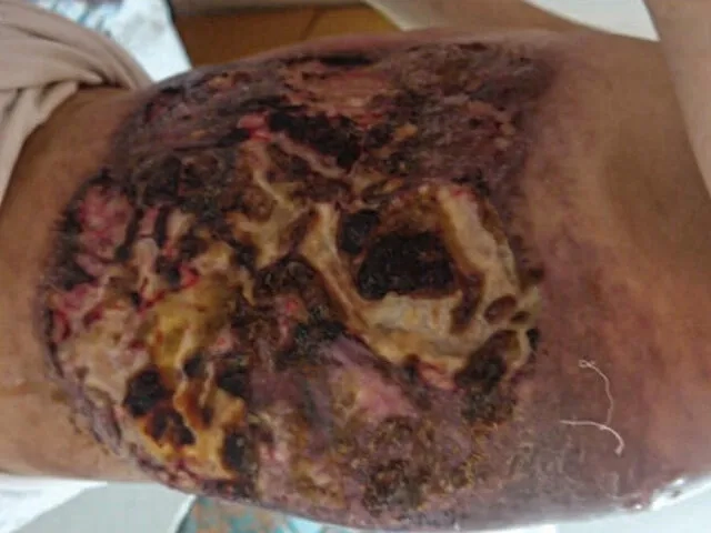 A medical team discussing a patient's zygomycosis treatment