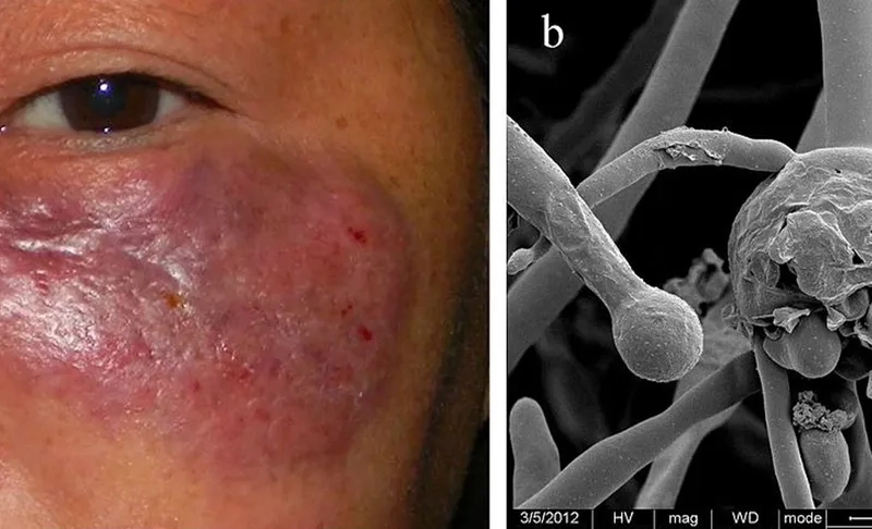 The link between black fungus in COVID-19 patients