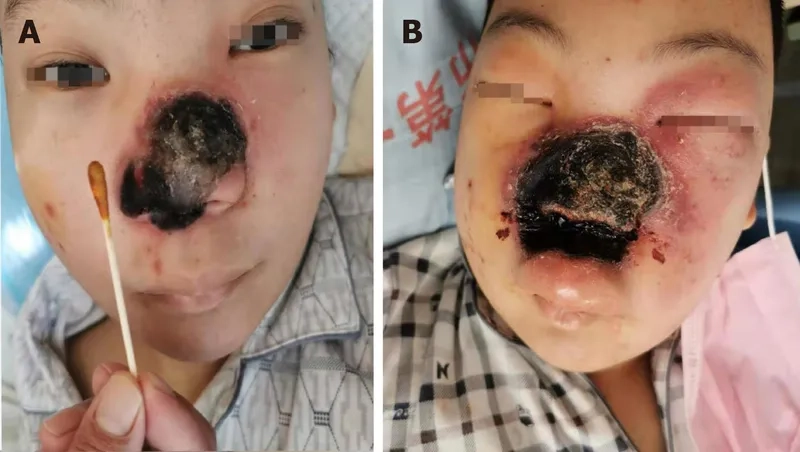 A medical illustration explaining what is zygomycosis