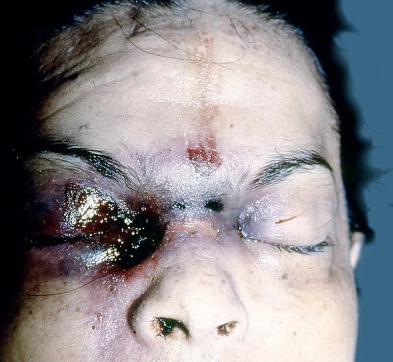 An infographic detailing the risk factors for mucormycosis