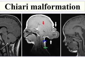 Living with a chiari malformation - A patient's guide