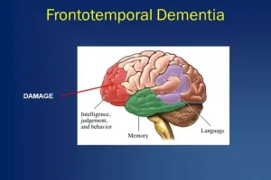 Frontotemporal dementia - A comprehensive guide