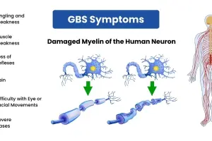 The challenging road to recovery from Guillain-Barré syndrome