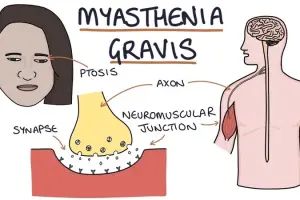 Myasthenia gravis - An autoimmune neuromuscular disease