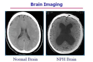 Normal pressure hydrocephalus - A guide to nph symptoms