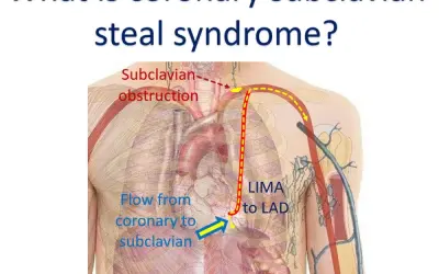 Subclavian Steal Syndrome what you need to understand