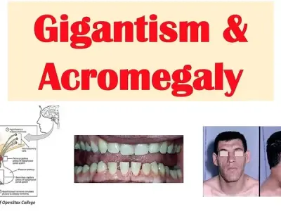 Acromegaly - When the body produces too much growth hormone