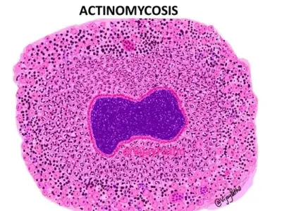 Diagnosing and treating the rare infection of actinomycosis