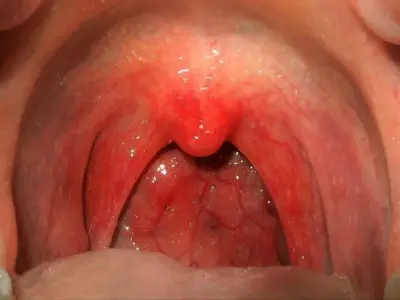 How to prevent adenovirus infection in children and adults