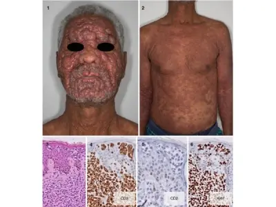 Understanding adult t-cell leukemia/lymphoma causes