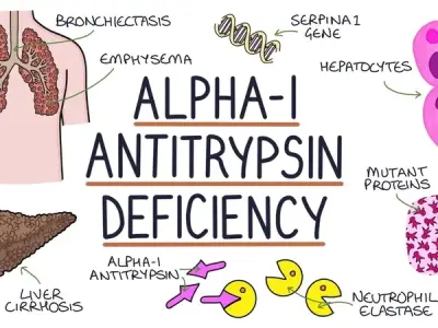 Alpha-1 antitrypsin deficiency - The genetic cause of COPD