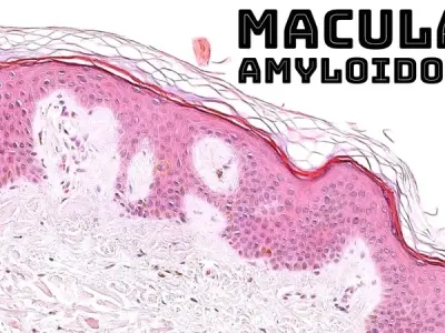 Amyloidosis - A guide to the different types and treatments