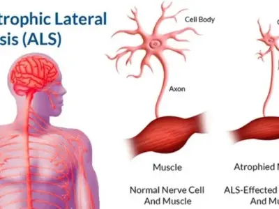 Amyotrophic lateral sclerosis - An essential guide