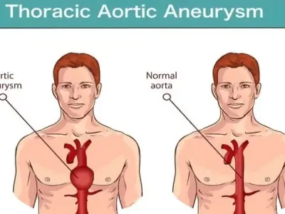 Understanding about aortic aneurysm thoracic abdominal