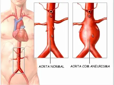 Aortic Aneurysm - How to detect disease before it breaks