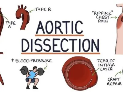 Aortic dissection causes symptoms and risk factors