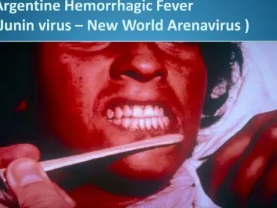Understanding argentine hemorrhagic fever symptoms early