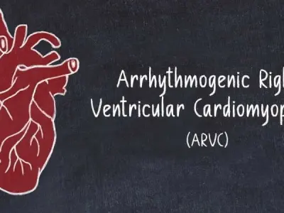 Arrhythmogenic Right Ventricular Cardiomyopathy (ARVC)