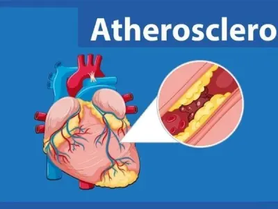 Atherosclerosis symptoms diagnosis and effective care