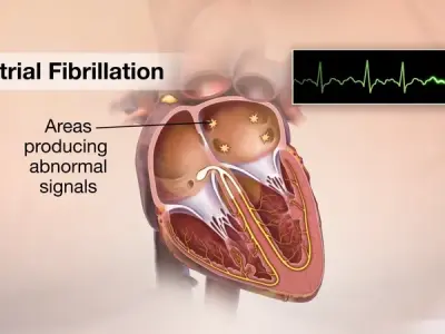 Atrial fibrillation - Managing the most common arrhythmia