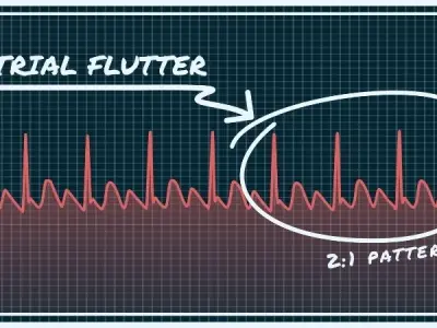 Understanding atrial flutter symptoms and prevention