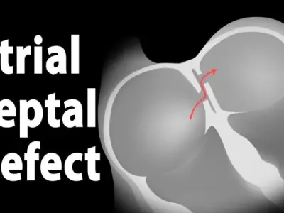 Atrial Septal Defect (ASD) Causes And Risk Factors Explained