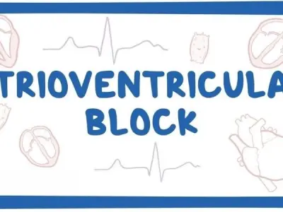 Exploring atrioventricular (AV) block symptoms and risk
