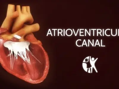 Atrioventricular Canal Defect (Endocardial Cushion Defect)