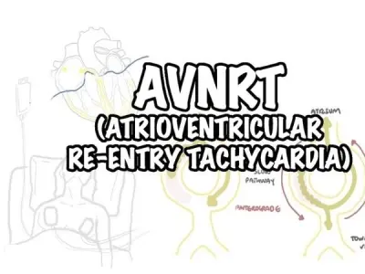 Atrioventricular Nodal Reentrant Tachycardia (AVNRT)