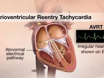 Understanding atrioventricular reentrant tachycardia (AVRT)