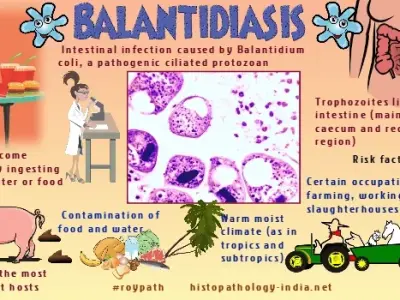 Balantidiasis - A rare intestinal parasitic infection