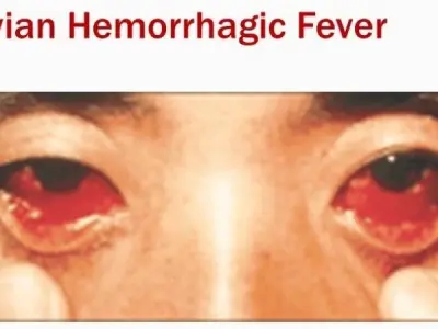 Symptoms and warning signs of Bolivian Hemorrhagic Fever