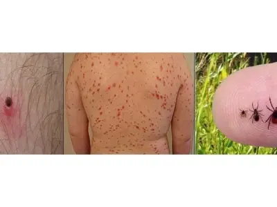 The hidden threat of ticks - Understanding bourbon virus disease