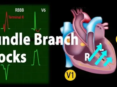 Risks of Bundle Branch Block (Left & Right) you must know