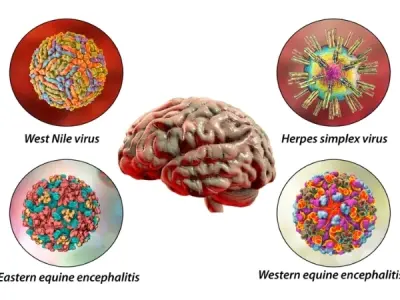 Understanding california encephalitis symptoms and risks