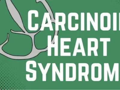 Carcinoid heart disease signs diagnosis and management