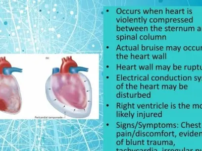 How Cardiac Contusion (Heart Trauma) affects your health