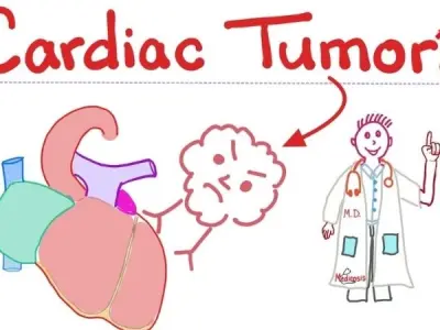 Cardiac Myxoma (Heart Tumor) latest research updates