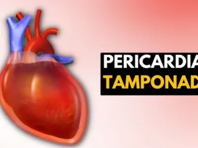 Causes and risk factors of Cardiac Tamponade explained